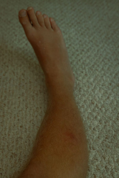 insect bite on leg with swelling, Puerto Vallarta, ArboursAbroad